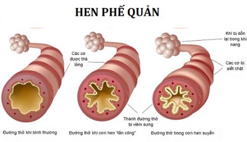 hen phế quản
