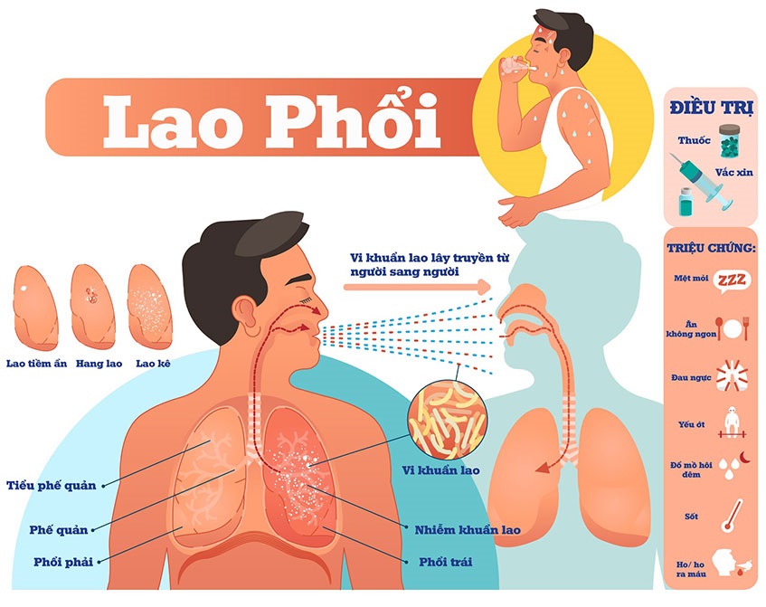 lao phổi