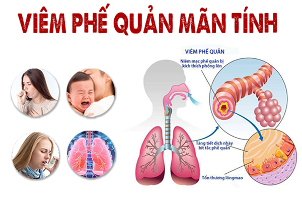 viêm phế quản
