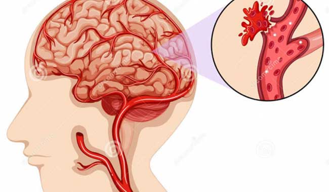 Cảnh báo 7 biến chứng nguy hiểm do tai biến mạch máu não gây ra