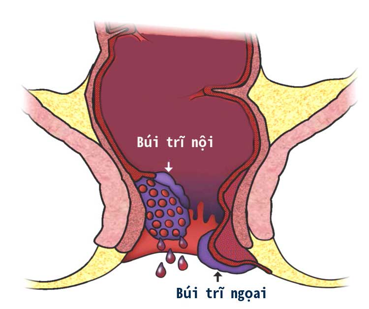 7 dấu hiệu của bệnh trĩ ngoại dễ nhận biết nhất.