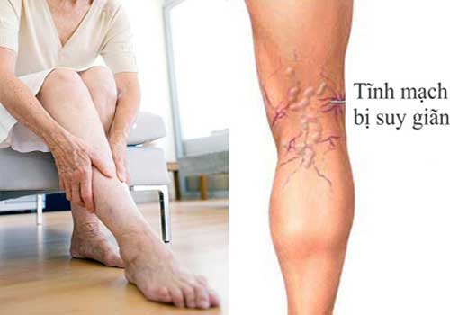 Hình ảnh chân bị suy giãn tĩnh mạch