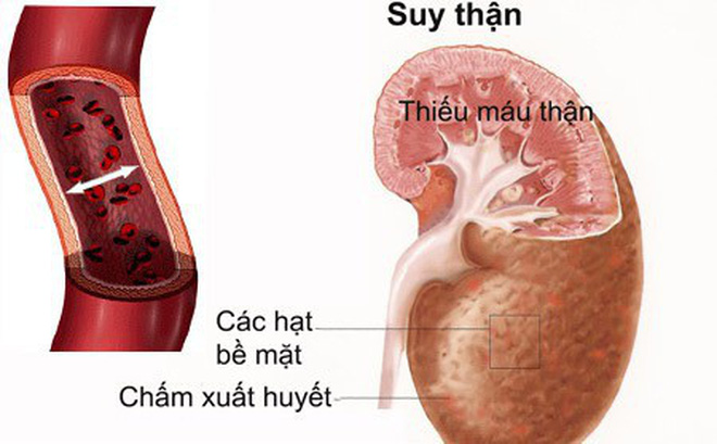 Biến chứng nguy hiểm nhất là suy thận