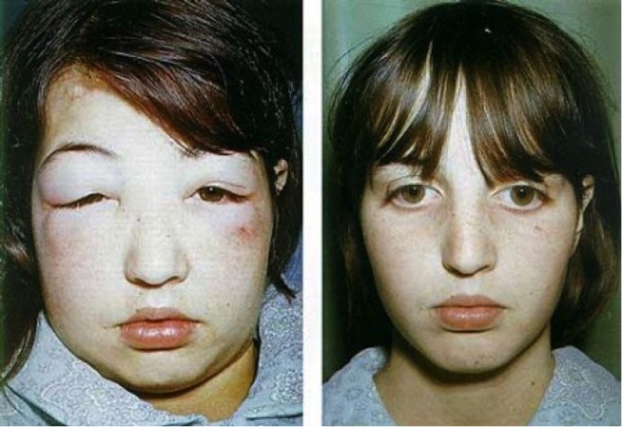 Phù nề là biểu hiện đặc trưng nhất của hội chứng thận hư