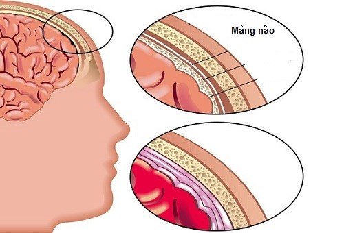 Do màng não bị viêm