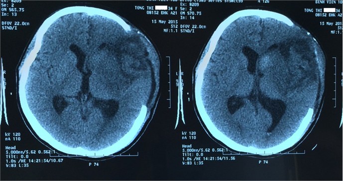 CT scan đầu để xác định bệnh