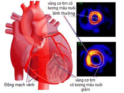 Do bệnh mạch vành
