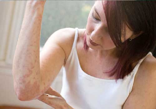 Nổi mẩn ở da, có thể đi từ dạng nhẹ như ban đỏ