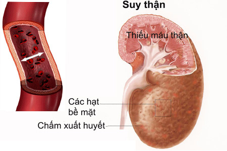 Tai biến thận: viêm thận, suy thận do tác dụng phụ thuốc kháng sinh