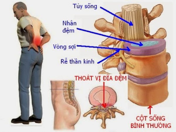 Thoát vị đĩa đệm