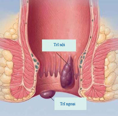 bệnh trĩ
