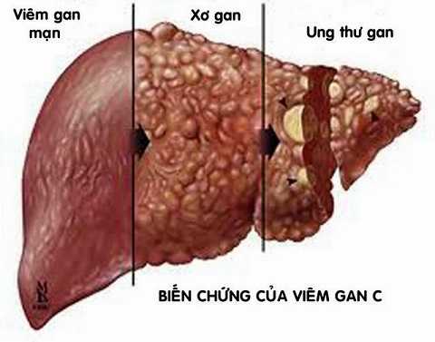 Viêm gan C gây ra nhiều biến chứng nguy hiểm