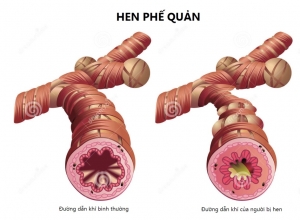 Bệnh hen suyễn có chữa khỏi được không - cách phòng ngừa và điều trị ra sao?