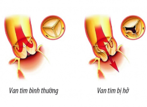 Những triệu chứng của bệnh hở van tim và cách điều trị hiệu quả