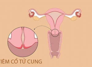 Dấu hiệu cảnh báo bạn mắc bệnh viêm cổ tử cung