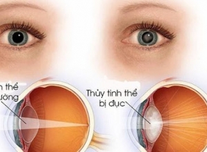 Mách bạn 5 bài thuốc dân gian chữa đục thủy tinh thể hiệu quả