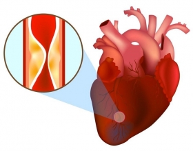 Những hiểu lầm về bệnh thiếu máu cơ tim - Có thể bạn chưa biết