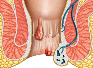 Top 13 mẹo dân gian chữa dứt điếm bệnh trĩ tại nhà cực hiệu quả