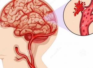 Cảnh báo 7 biến chứng nguy hiểm do tai biến mạch máu não gây ra