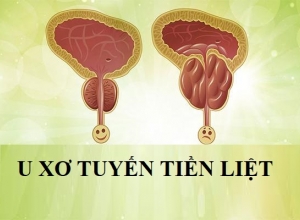 Mẹo chữa u xơ tiền liệt tuyến bằng thuốc nam hiệu quả