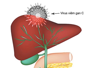 Viêm gan C có lây không và lây qua đường nào?