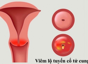 Đốt viêm lộ tuyến tử cung bao lâu thì khỏi? có ảnh hưởng đến sinh nở không?