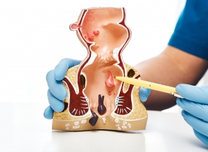 Cắt trĩ xong có tái phát không? Làm gì để ngăn ngừa tái phát trĩ sau khi phẫu thuật? 