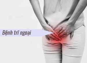 7 cách làm co búi trĩ ngoại hiệu quả bạn nên biết