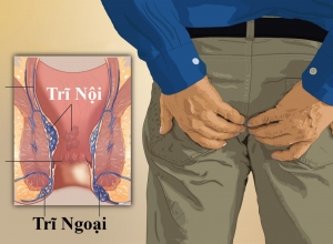 Top 7 cách phòng bệnh trĩ đơn giản hiệu quả
