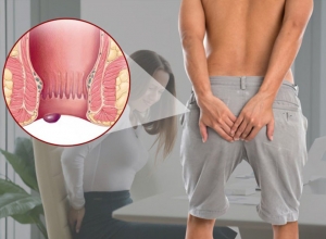 Bệnh trĩ giai đoạn đầu: Biểu hiện và cách chữa
