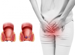 Dấu hiệu cảnh báo bệnh trĩ ở nữ giới mà chị em nên biết