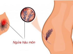 Nguyên nhân nào gây ngứa búi trĩ? Làm cách nào để khắc phục?