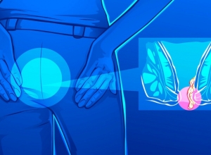Trĩ hỗn hợp độ 3 có nguy hiểm không? Cần lưu ý gì khi bị trĩ hỗn hợp?