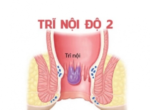Trĩ nội độ 2 có tự khỏi không? Điều trị trĩ nội độ 2 như nào?
