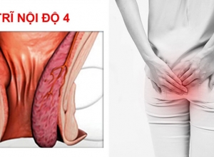 Triệu chứng của trĩ nội độ 4 và mức độ nguy hiểm của bệnh