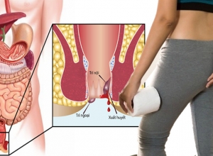 Người bị bệnh trĩ nên kiêng tuyệt đối những gì?
