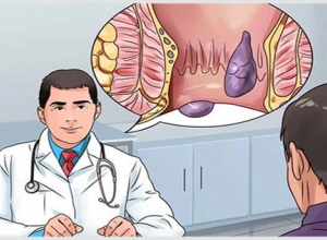 Búi trĩ có mủ là gì? Cách chữa bệnh trĩ có mủ hiệu quả