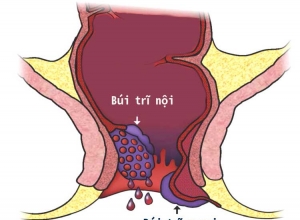 7 dấu hiệu của bệnh trĩ ngoại dễ nhận biết nhất.
