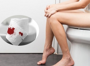 Bị trĩ đi ngoài ra máu thì phải xử lý như nào? Tìm hiểu ngay để biết