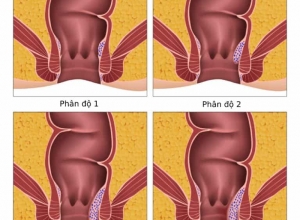 Bệnh trĩ nội: Các biểu hiện và cách điều trị qua từng giai đoạn bệnh