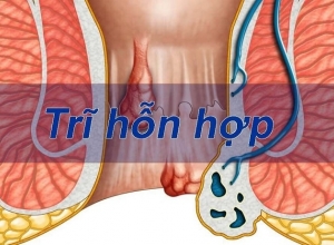 Trĩ hỗn hợp độ 4 gây ra những nguy hiểm gì?