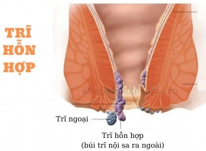 5 dấu hiệu cảnh báo bạn đã mắc bệnh trĩ hỗn hợp