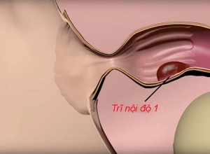 Nguyên nhân nào gây bệnh trĩ nội độ 1? Cách điều trị bệnh như nào?