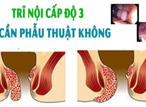 Bệnh trĩ nội độ 3 có cần phẫu thuật không?