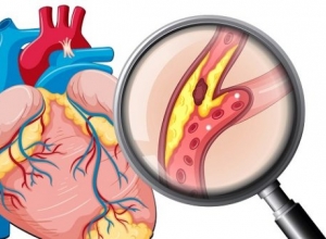 Nguyên nhân gây ra bệnh mạch vành là gì? Cách khắc phục như nào?