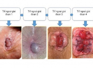 Làm thế nào để phân biệt các cấp độ của bệnh trĩ ngoại? Tìm hiểu ngay để biết