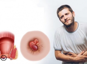 Cách chữa bệnh trĩ tại nhà đơn giản, giúp bạn tạm biệt nỗi đau bệnh trĩ