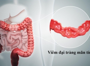 Viêm đại tràng mãn tính nguy hiểm như thế nào? 3 biến chứng khó lường của viêm đại tràng mãn tính