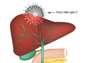Bị nhiễm virus viêm gan C sống được bao lâu? Tìm hiểu ngay để biết.