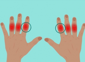 9 triệu chứng điển hình của viêm khớp ngón tay và cách điều trị hiệu quả. 